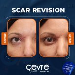 Narbenkorrektur Vorher-Nachher-Ergebnis bei Adem and Havva Medical Center, verbesserte Stirnnarbe
