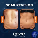 Vorher-nachher-Ergebnis der Narbenkorrektur bei Adem and Havva Medical Center, glatte Bauchhaut