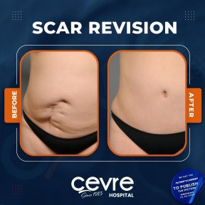 Vorher-nachher-Ergebnis der Narbenkorrektur bei Adem and Havva Medical Center, glatter Bauch