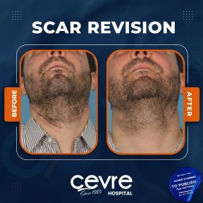 Vorher-nachher-Ergebnis der Narbenkorrektur am Hals bei Adem and Havva Medical Center, bessere Haut