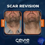 Vorher-nachher-Ergebnis der Narbenkorrektur am Hals bei Adem and Havva Medical Center, bessere Haut