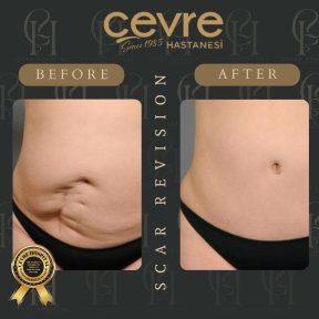 Vorher-nachher-Ergebnis der Narbenkorrektur bei Adem and Havva Medical Center, glatter Bauch