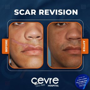 Narbenkorrektur Vorher-Nachher-Ergebnisse in Cevre Hospital, verbesserte Gesichtsnarbe