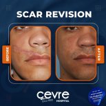 Narbenkorrektur Vorher-Nachher-Ergebnisse in Cevre Hospital, verbesserte Gesichtsnarbe