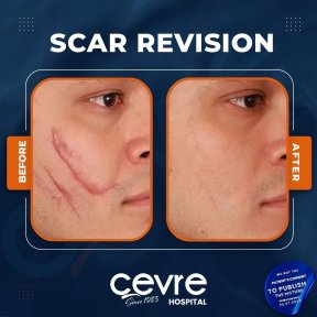 Vorher-nachher-Ergebnisse der Narbenkorrektur bei Adem and Havva Medical Center, verbesserte Gesichtshaut