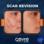 Vorher-nachher-Ergebnisse der Narbenkorrektur bei Adem and Havva Medical Center, verbesserte Gesichtshaut