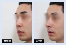 نتائج قبل وبعد عملية تصحيح انحراف الحاجز الأنفي في URBAN Plastic Surgery