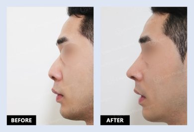 نتائج قبل وبعد عملية تصحيح الحاجز الأنفي في URBAN Plastic Surgery وتحسن شكل الأنف