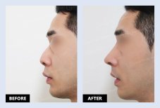 نتائج قبل وبعد عملية تصحيح الحاجز الأنفي في URBAN Plastic Surgery وتحسن شكل الأنف