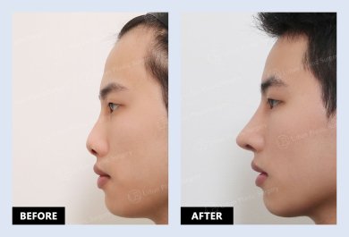 نتائج قبل وبعد عملية تصحيح انحراف الحاجز الأنفي في URBAN Plastic Surgery
