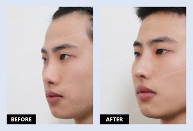 نتائج قبل وبعد عملية تصحيح الحاجز الأنفي في URBAN Plastic Surgery
