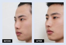 نتائج قبل وبعد عملية تصحيح الحاجز الأنفي في URBAN Plastic Surgery