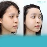 Before and after forehead contouring results at Wansiri Hospital, smoother forehead shape