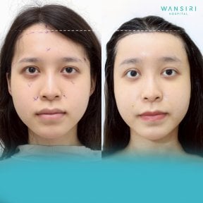 Before and after forehead contouring results at Wansiri Hospital, improved forehead shape