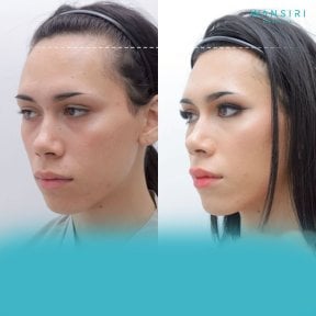 Forehead contouring before and after results at Wansiri Hospital, facial feminization surgery
