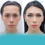 Before and after forehead contouring results at Wansiri Hospital, facial feminization surgery