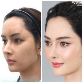 Before and after forehead contouring results at Wansiri Hospital, enhanced facial profile