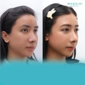 Before and after forehead contouring results at Wansiri Hospital, smoother forehead profile