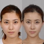 Результаты до и после контурирования лица, улучшена симметрия и четкость