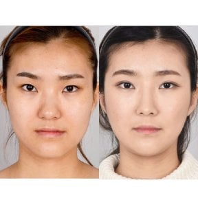 Результаты контурирования лица до и после, улучшение симметрии и линии подбородка