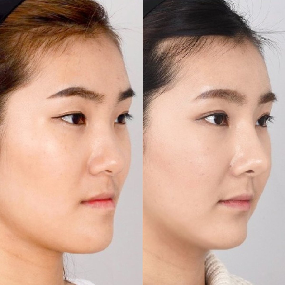 Resultados de contorno facial antes y después, mejora visible de mandíbula y mentón
