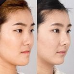 Результаты контурирования лица до и после, видимое улучшение подбородка и челюсти