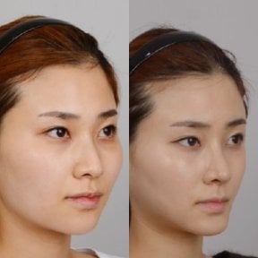 Результаты контурирования лица до и после, улучшение линии подбородка и щек