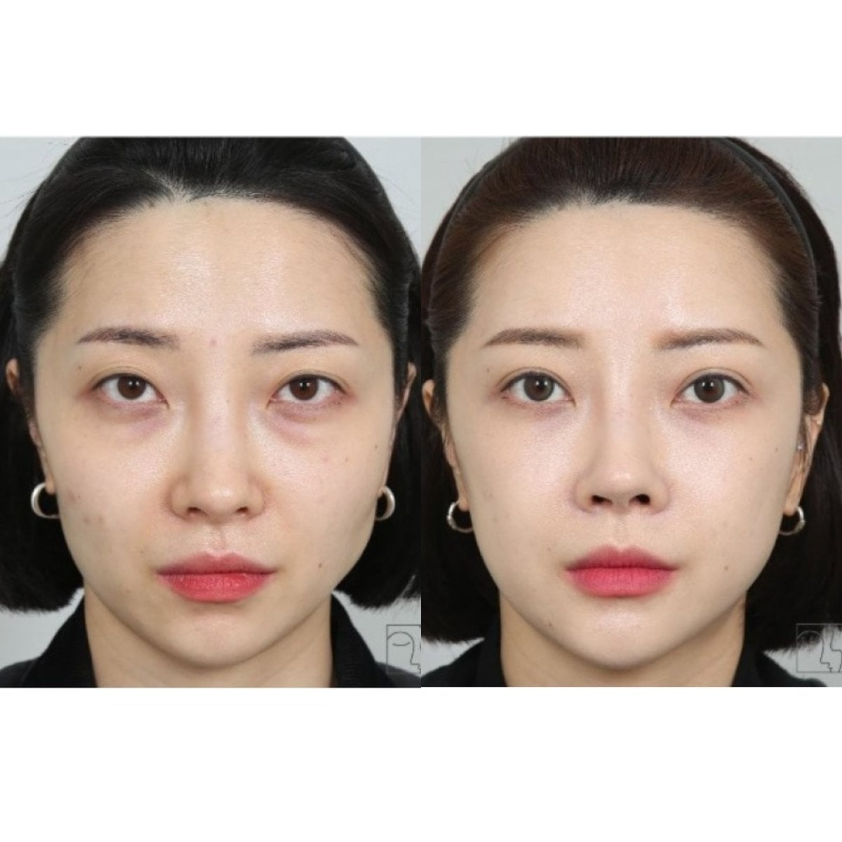 Resultados de lifting facial antes y después – rejuvenecimiento y piel más suave