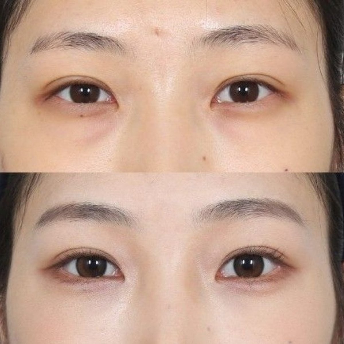 Resultados de blefaroplastia antes y después, corrección de párpados para mirada juvenil
