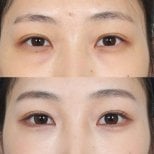 نتائج رأب الجفن قبل وبعد، تصحيح الجفون لمظهر عيون أكثر شبابًا