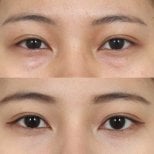 Before and after blepharoplasty results – eyelid correction with natural look improvement