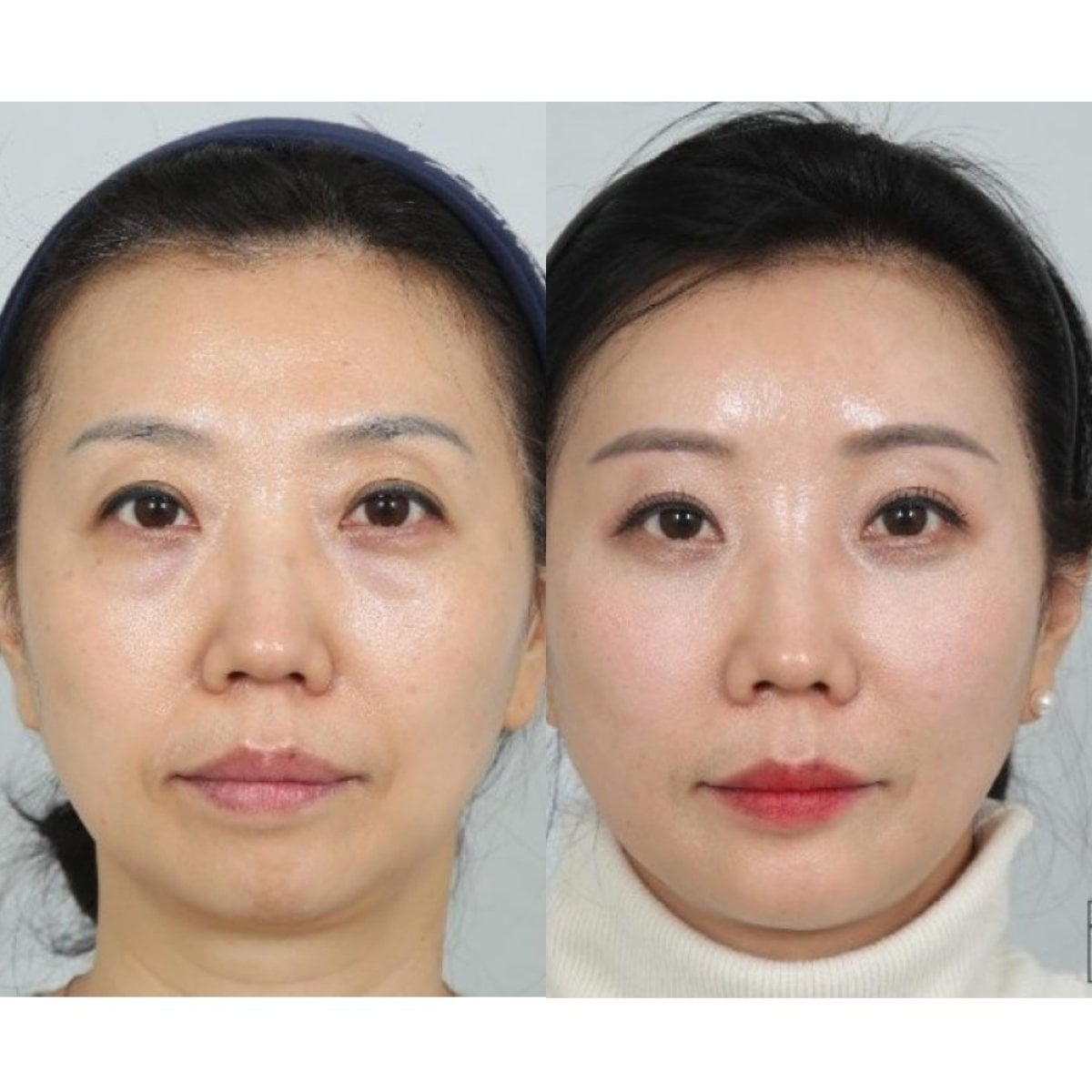 Resultados de blefaroplastia antes y después, corrección de párpados para mirada juvenil