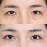 نتائج رأب الجفن قبل وبعد، تصحيح الجفون لمظهر عيون أكثر انتعاشًا