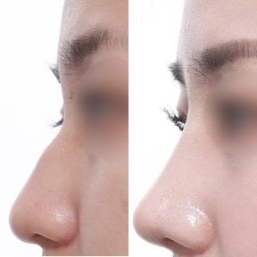 Vorher-nachher-Ergebnis der Nasenkorrektur, verbesserte Nasenform nach OP