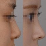 Vorher-nachher-Ergebnis der Nasenkorrektur, verbesserte Profil- und Nasensymmetrie