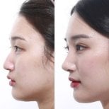 Vorher-nachher-Ergebnis der Nasenkorrektur, natürliche Profilverbesserung