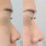 Vorher-nachher-Ergebnisse der Nasenkorrektur, verbesserte Nasenform und Profil