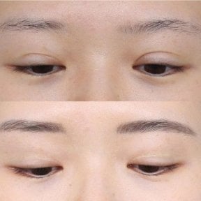 Before and after double eyelid surgery results, visible eyelid crease enhancement