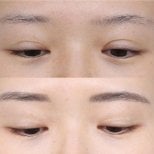 Before and after double eyelid surgery results, visible eyelid crease enhancement