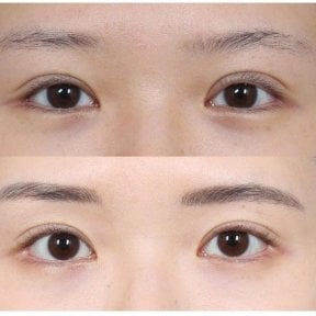 Before and after double eyelid surgery results, visible eyelid crease enhancement