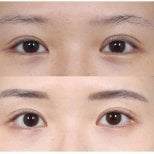 Before and after double eyelid surgery results, visible eyelid crease enhancement