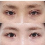 Before and after double eyelid surgery results, visible eyelid crease enhancement