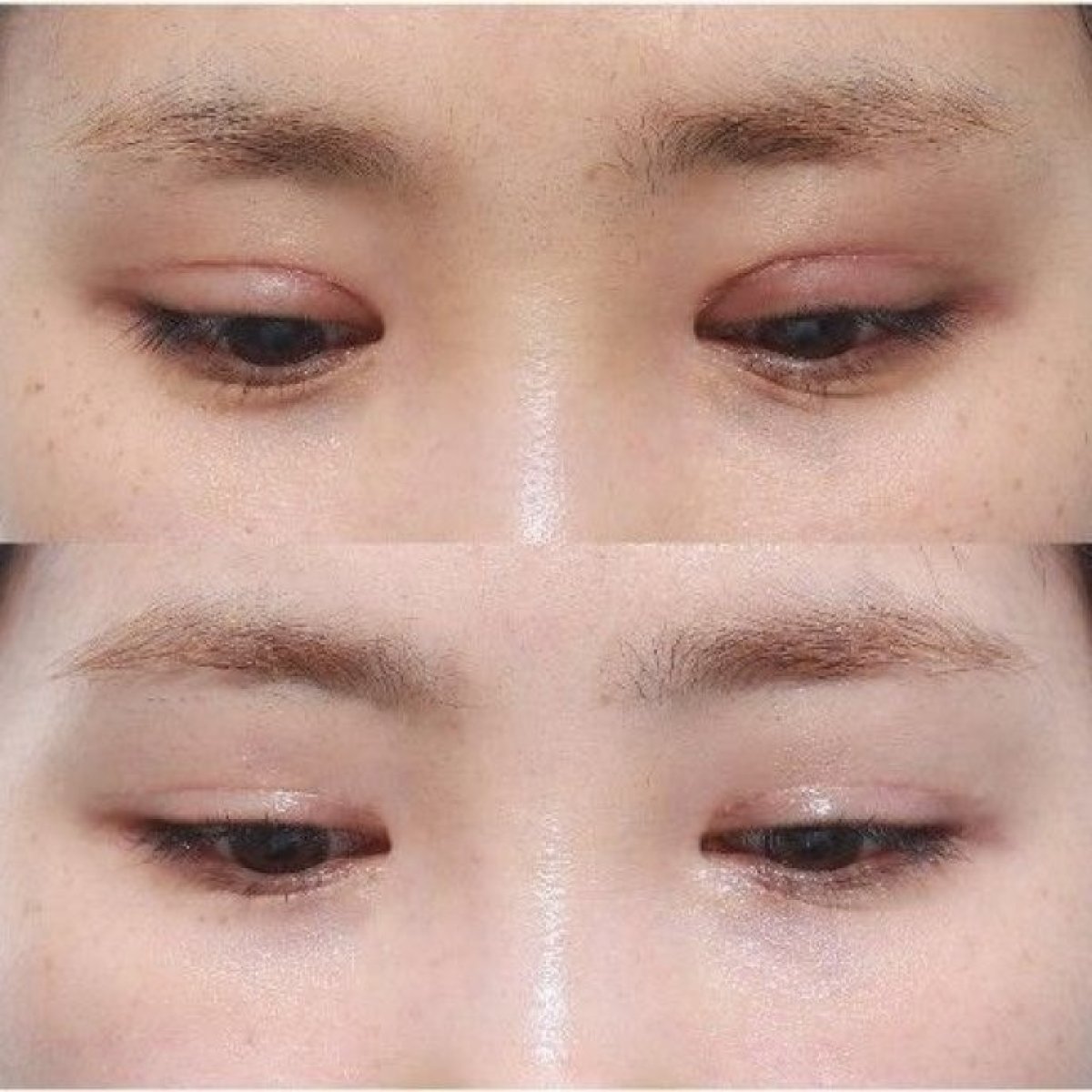 Resultados antes y después de cirugía de doble párpado, pliegue del párpado visible