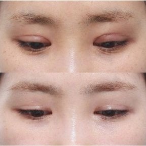 Before and after double eyelid surgery results, visible eyelid crease enhancement
