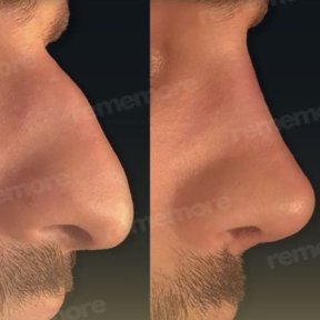 Before and after male rhinoplasty results at Memorial Şişli Hospital, improved nose profile