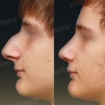 Before and after male rhinoplasty results at Memorial Şişli Hospital, improved nose profile