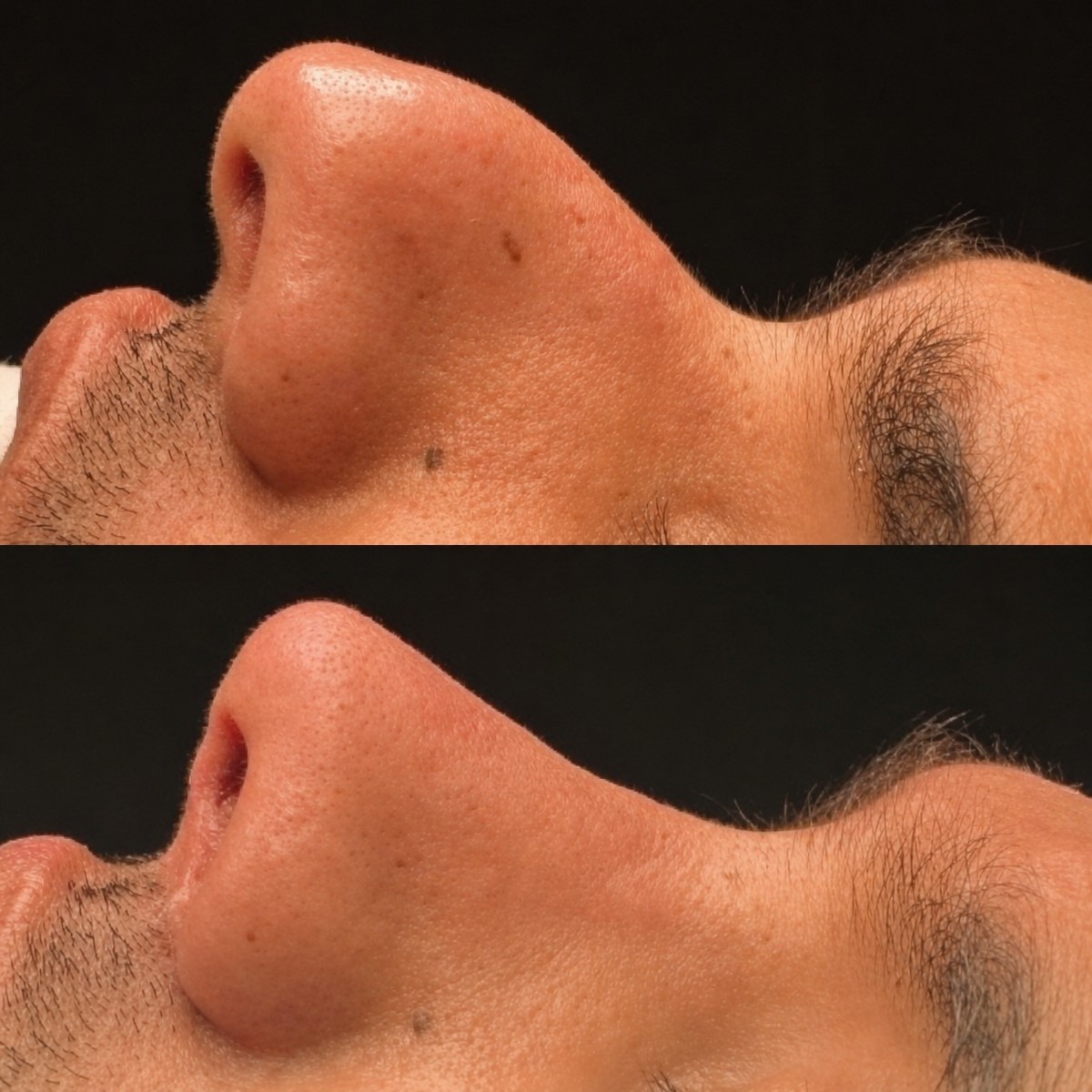 Resultados de rinoplastia masculina antes y después en Memorial Şişli Hospital, perfil mejorado