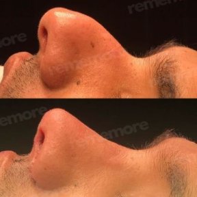 Before and after male rhinoplasty results at Memorial Şişli Hospital, improved nose profile