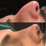 Before and after male rhinoplasty results at Memorial Şişli Hospital, improved nose profile
