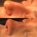 Before and after male rhinoplasty results at Memorial Şişli Hospital, improved nose profile